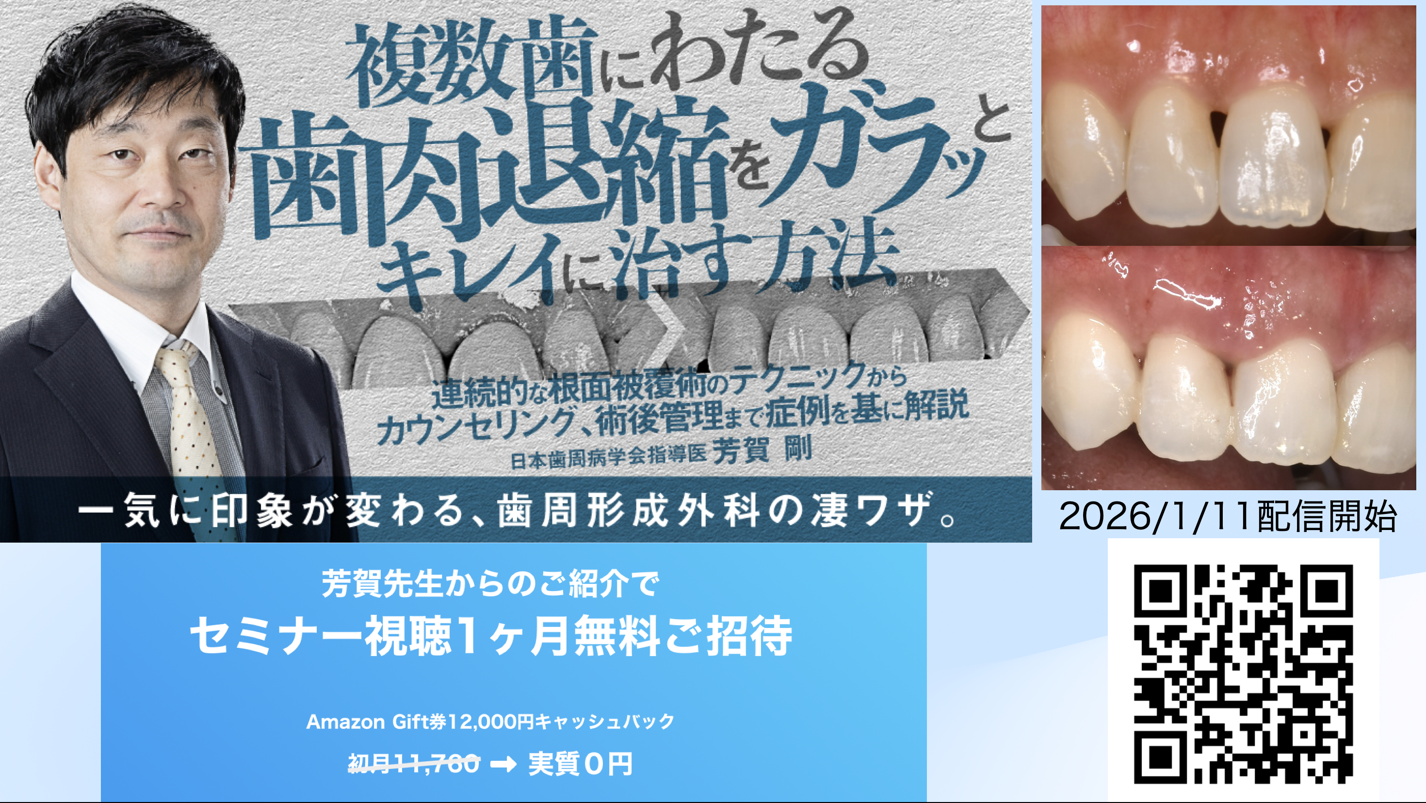 複数歯にわたる歯肉退縮をガラッとキレイに治す方法
